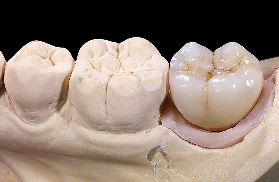 Implant Restoration
